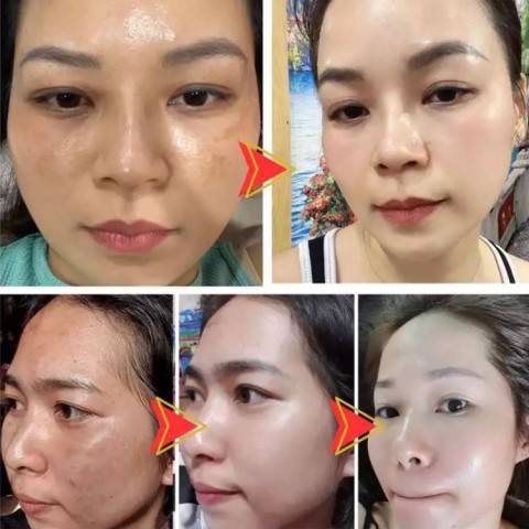 Whitening and anti-freckle cream