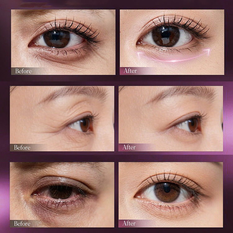 Mid-Year Mega Sale – Buy 1 Take 1-Calcium Dark Spot Eye Cream-Dark Circle, Anti-aging, Sagging, Elasticity