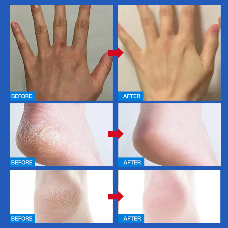 Vaseline Peach Moisturizing Stick - Get rid of cracked/peeling/black joints of hands and feet